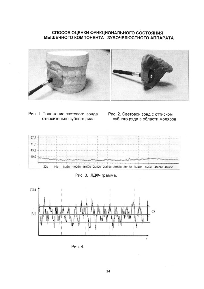Способ оценки функционального состояния мышечного компонента зубочелюстного аппарата (патент 2616179)