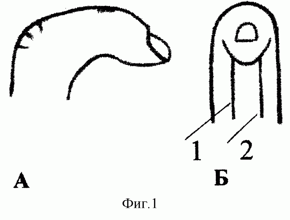 Способ устранения сгибательных контрактур пальцев кисти (патент 2263477)