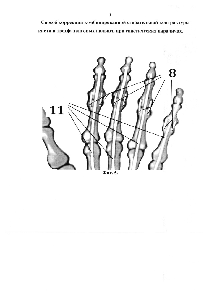 Способ коррекции комбинированной сгибательной контрактуры кисти и трехфаланговых пальцев при спастических параличах (патент 2648862)