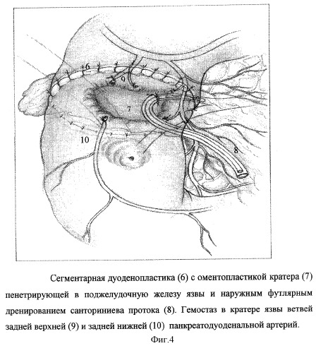 Способ хирургического лечения низкой околососочковой осложненной язвы двенадцатиперстной кишки с повреждением санториниева протока и стриктурой большого дуоденального сосочка (патент 2292847)