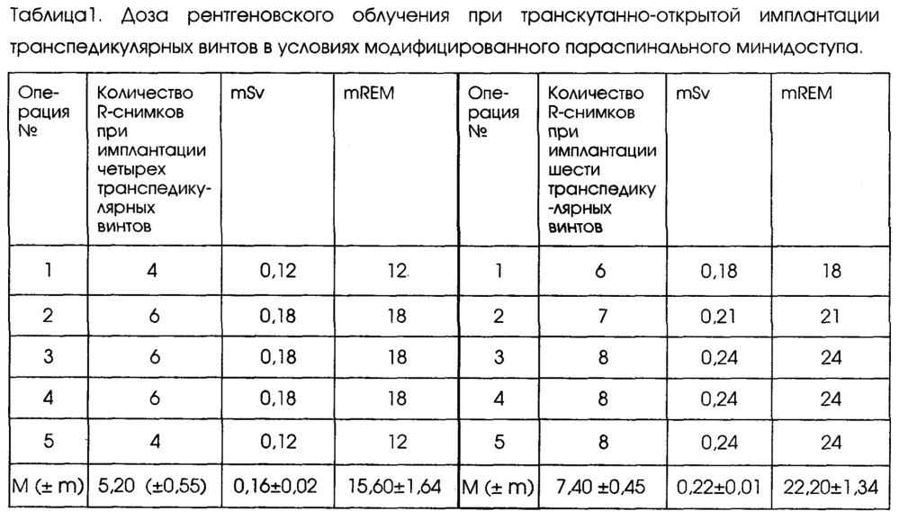 Способ снижения лучевой нагрузки при транскутанно-открытой установке транспедикулярных винтов в условиях параспинального минидоступа (патент 2613601)