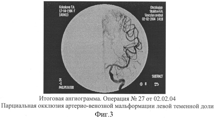 Способ эмболизации артериовенозных мальформаций головного мозга в условиях общей анестезии и управляемой гипотонии (патент 2315634)