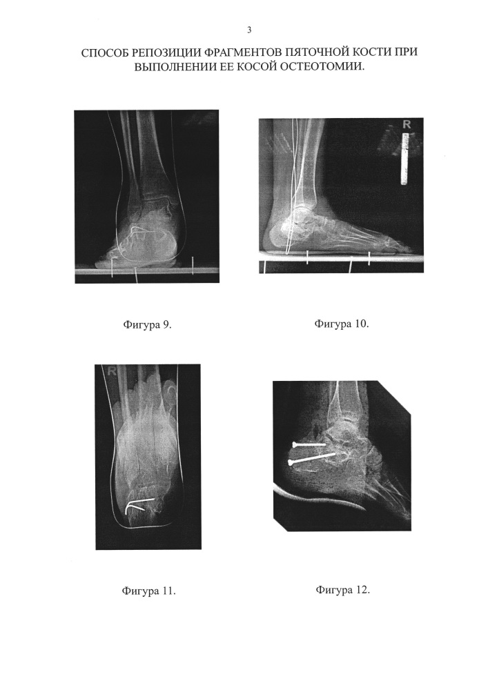 Способ репозиции фрагментов пяточной кости при выполнении ее косой остеотомии (патент 2661705)