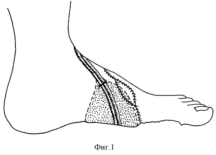 Способ замещения посттравматических дефектов тканей опорной поверхности стопы (патент 2290144)