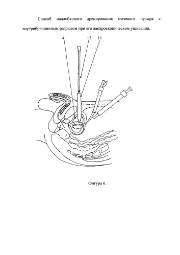 Способ надлобкового дренирования мочевого пузыря с внутрибрюшинным разрывом при его лапароскопическом ушивании (патент 2592023)