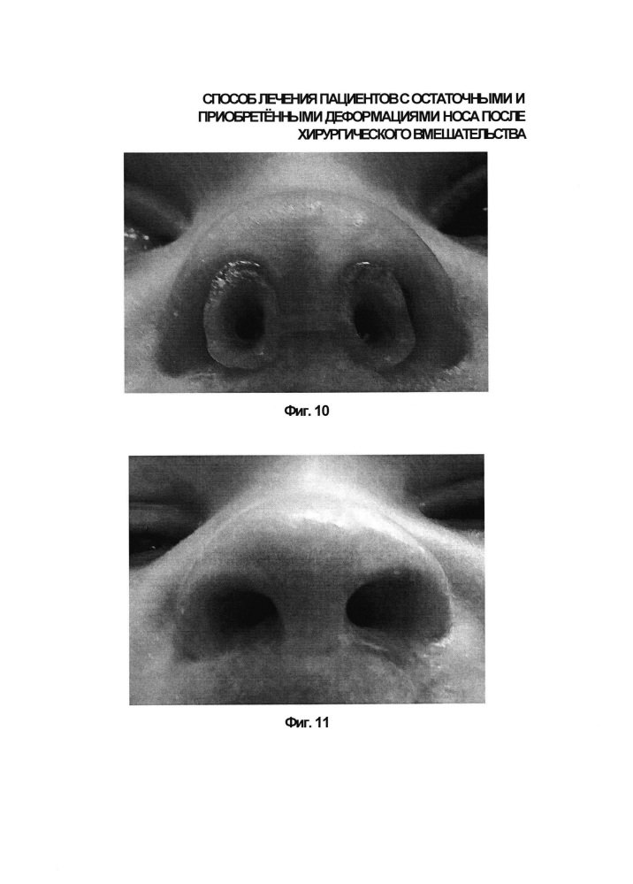 Способ лечения пациентов после хирургического вмешательства, выполненного по поводу остаточных и приобретённых деформаций носа (патент 2630130)