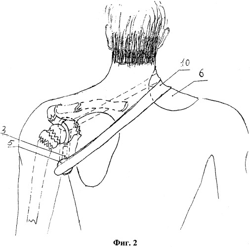Медицинская транспортная шина для плечевого пояса (патент 2491039)