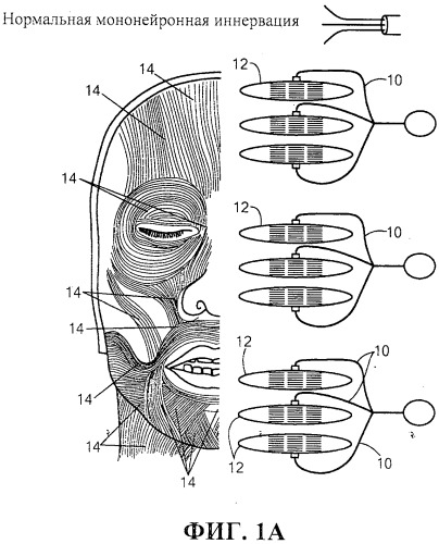 Система и способ стимуляции лицевого нерва (патент 2511082)