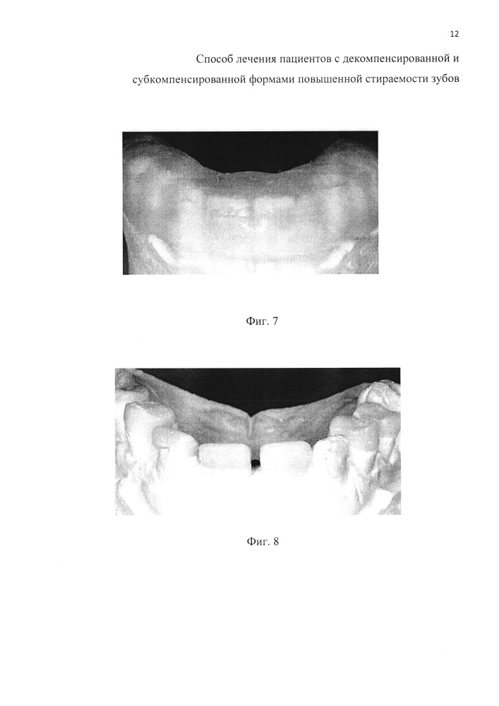 Способ лечения пациентов с декомпенсированной и субкомпенсированной формами повышенной стираемости зубов (варианты) (патент 2615121)