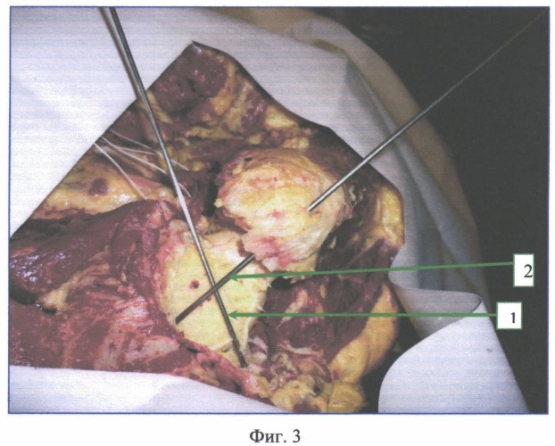 Способ анатомо-хирургического моделирования угла горизонтальной инклинации в тазобедренном суставе человека в эксперименте (патент 2547781)