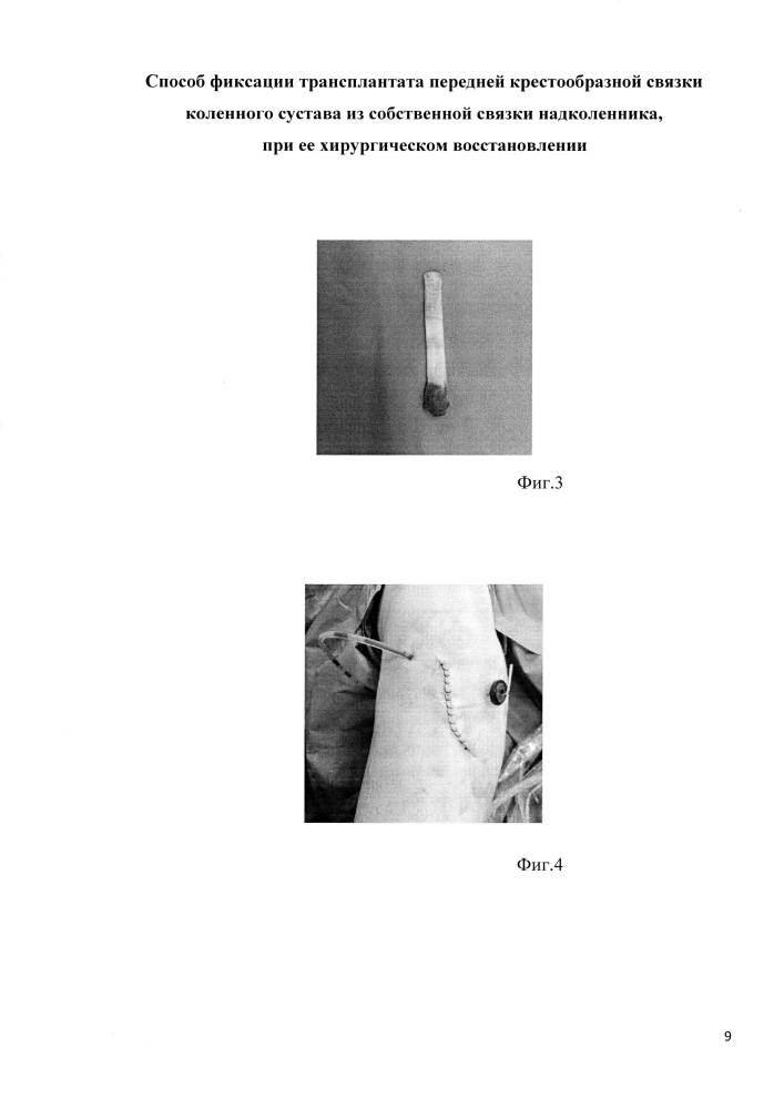 Способ фиксации трансплантата передней крестообразной связки коленного сустава из собственной связки надколенника, при её хирургическом восстановлении (патент 2597992)
