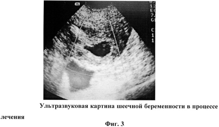 Способ комплексного лечения шеечной беременности (патент 2514548)