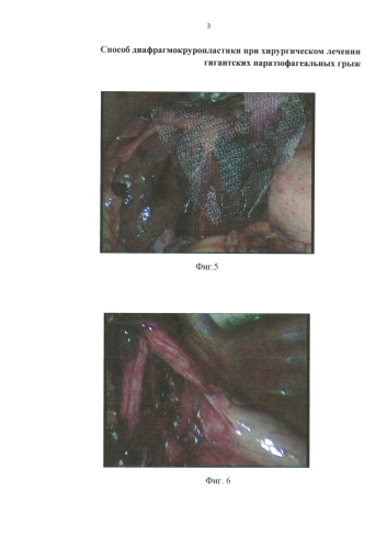 Способ диафрагмокруропластики при хирургическом лечении гигантских параэзофагеальных грыж (патент 2573794)