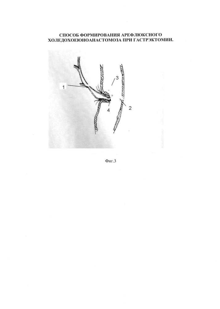 Способ формирования арефлюксного холедохоеюноанастомоза при гастрэктомии (патент 2665181)