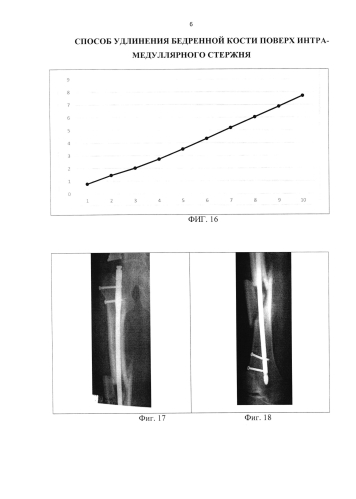 Способ удлинения бедренной кости поверх интрамедуллярного стержня (патент 2584555)