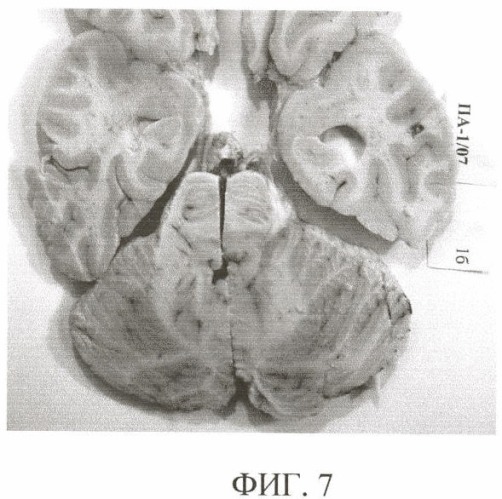 Способ комплексной посмертной патоморфологической диагностики заболеваний головного мозга (патент 2355311)