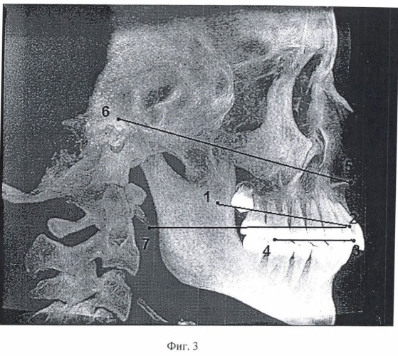 Способ нахождения анатомической плоскости, являющейся параллельной плоскости окклюзии (патент 2471452)