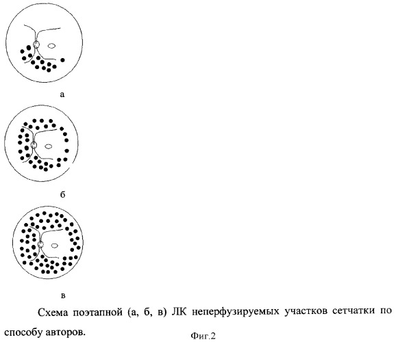 Способ лечения экссудативной макулопатии у больных с ретинитом коатса (патент 2371152)