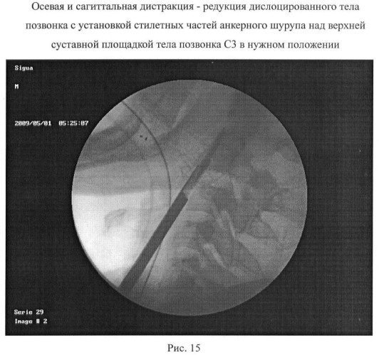 Способ анкерной коррекции и фиксации травматических дислокаций тела позвонка с2 при переломах палача (патент 2463978)