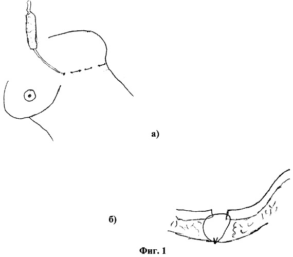 Способ формирования субмаммарной складки (патент 2355331)