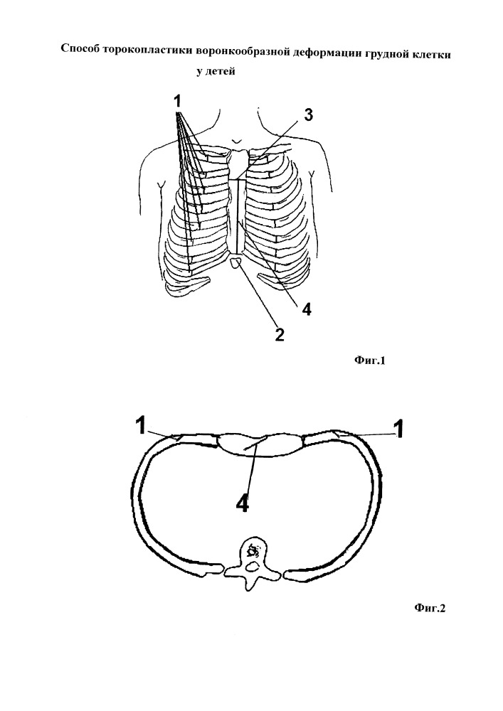 Способ торокопластики воронкообразной деформации грудной клетки (патент 2653264)