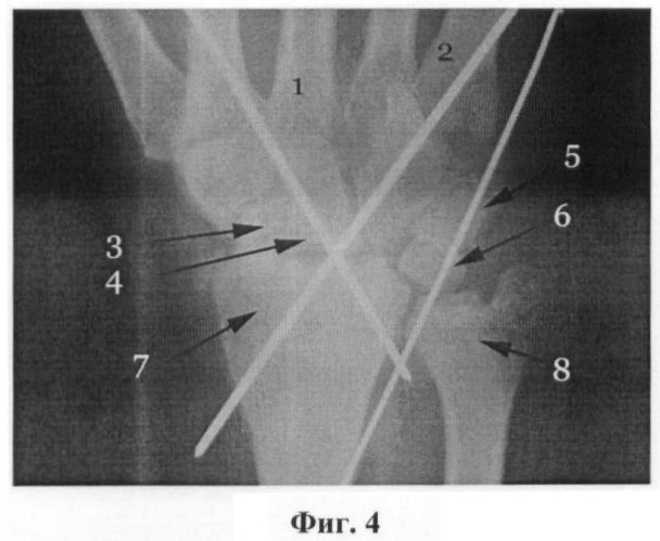 Способ артродеза лучезапястного сустава у детей с вялыми параличами верхней конечности (патент 2463984)