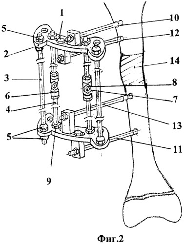 Устройство для удлинения бедренной кости с одновременным восстановлением биомеханической оси конечности (патент 2452419)