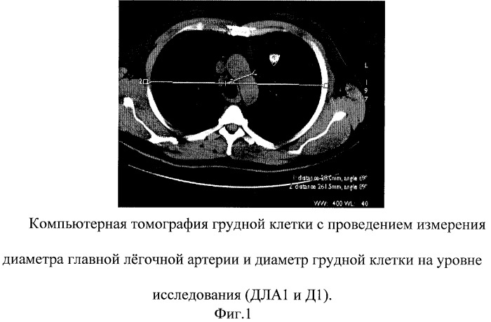 Способ компьютерной диагностики степени легочной гипертензии (патент 2269931)