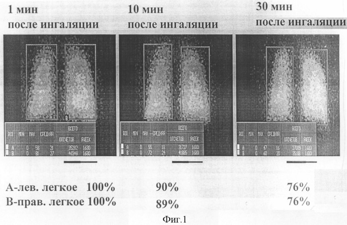 Способ диагностики тромболии мелких ветвей легочной артерии (патент 2303950)