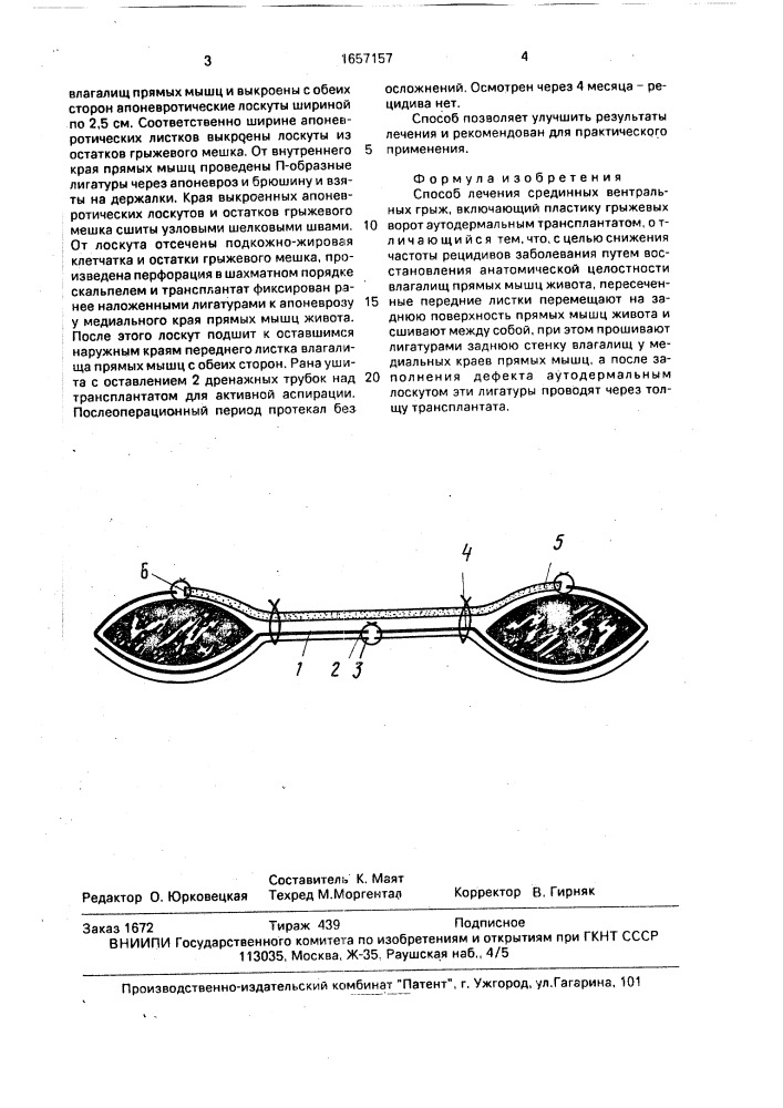 Способ лечения срединных вентральных грыж (патент 1657157)