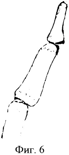 Способ лечения энхондром фаланг и пястных костей кисти (патент 2489107)