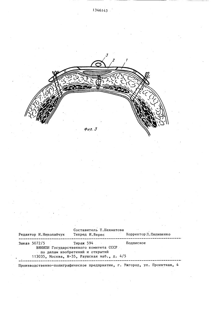 Способ профилактики эвентрации (патент 1346143)