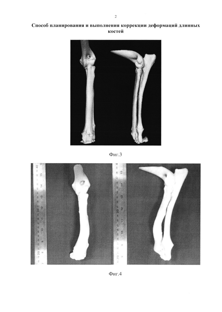 Способ планирования и выполнения коррекции деформаций длинных костей (патент 2641840)