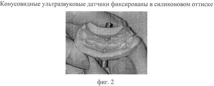 Способ эхоостеометрии челюстей в ретенционном периоде ортодонтического лечения (патент 2541038)