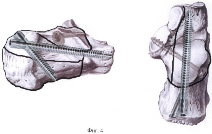 Способ лечения внутрисуставных импрессионных переломов пяточной кости (патент 2484785)