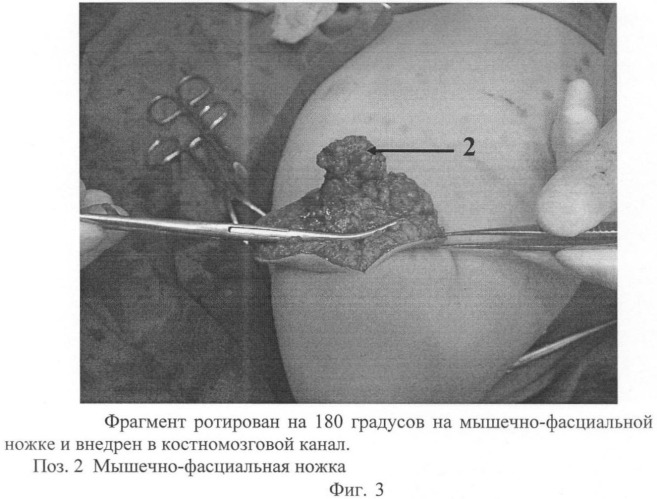 Способ устранения синдрома врастания торца культи плеча в мягкие ткани (патент 2394515)