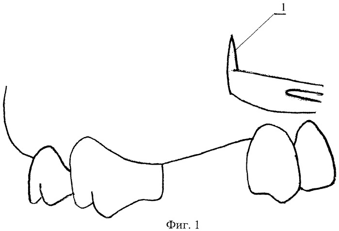 У кита альвеолярные легкие. Перелом альвеолярного отростка верхней челюсти рентген. Деформация альвеолярный отросток верхнечелюстной. Атрофия альвеолярного отростка. Альвеолярный отросток верхней челюсти.