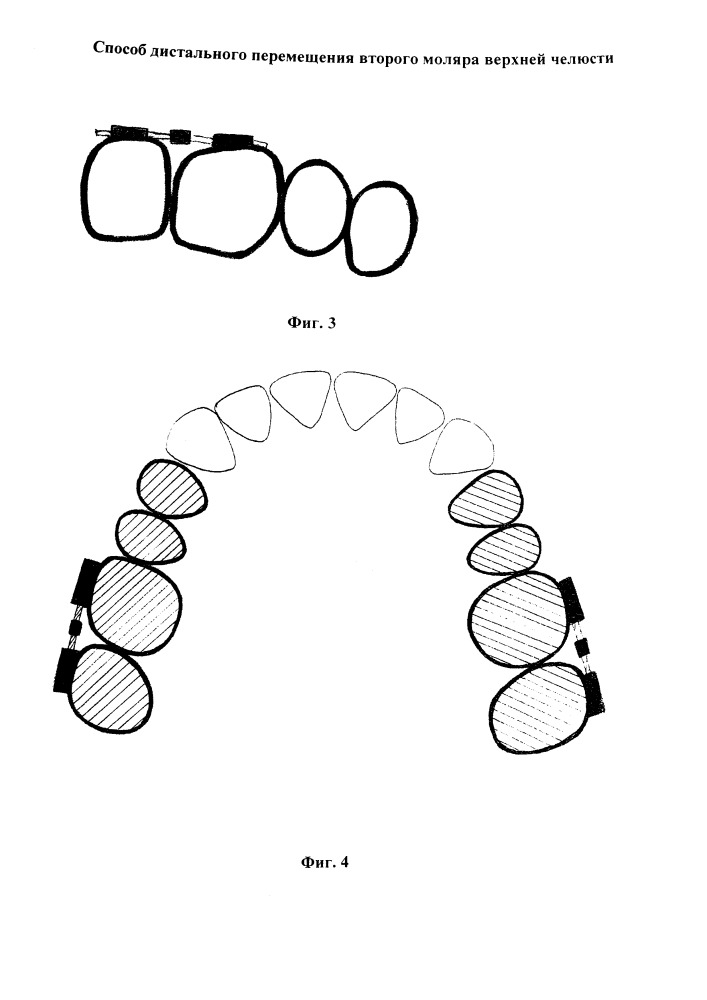 Способ дистального перемещения второго моляра верхней челюсти (патент 2656526)