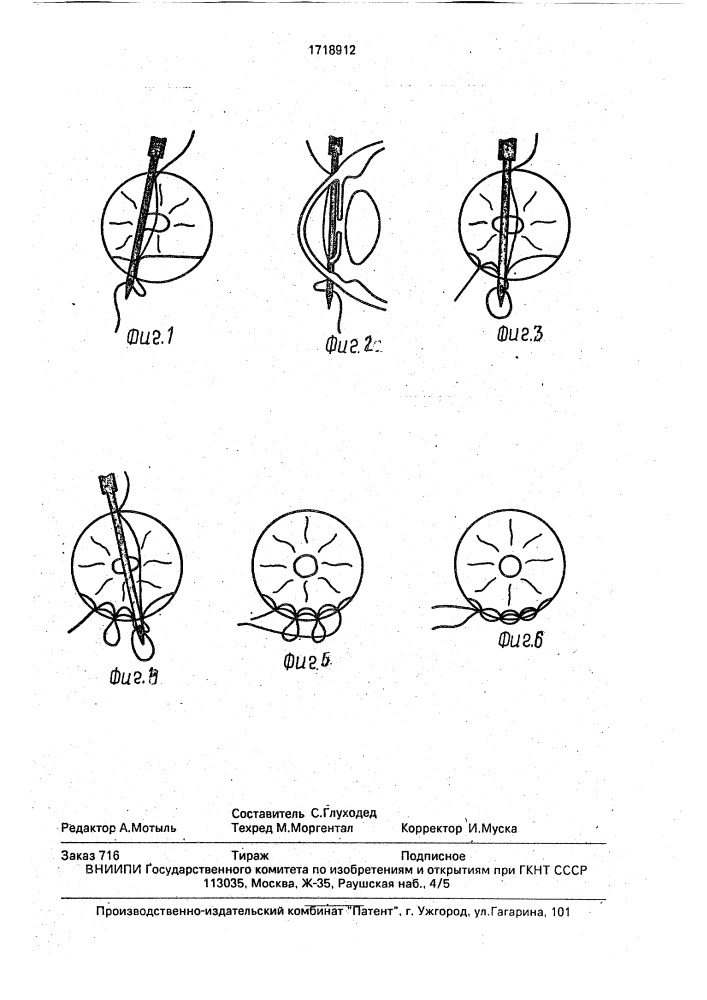 Способ устранения иридодиализа (патент 1718912)