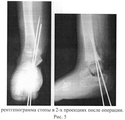 Способ устранения эквино-плоско-вальгусной деформации стопы при продольной эктромелии голени и наличии тарзальной коалиции (патент 2535618)