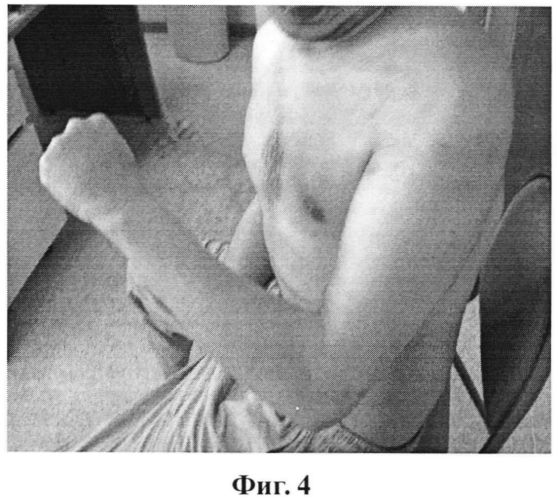 Способ формирования двигательного стереотипа после операций сухожильно-мышечных траснпозиций у пациентов с парезами, параличами и утратой мышц (патент 2559583)