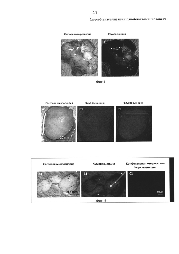 Способ визуализации глиобластомы человека (патент 2654665)