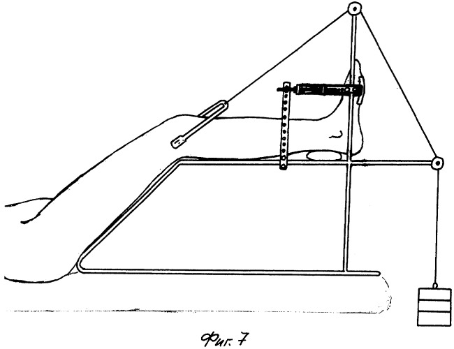 Устройство для оптимизации условий для сращения переломов бедра (патент 2266081)