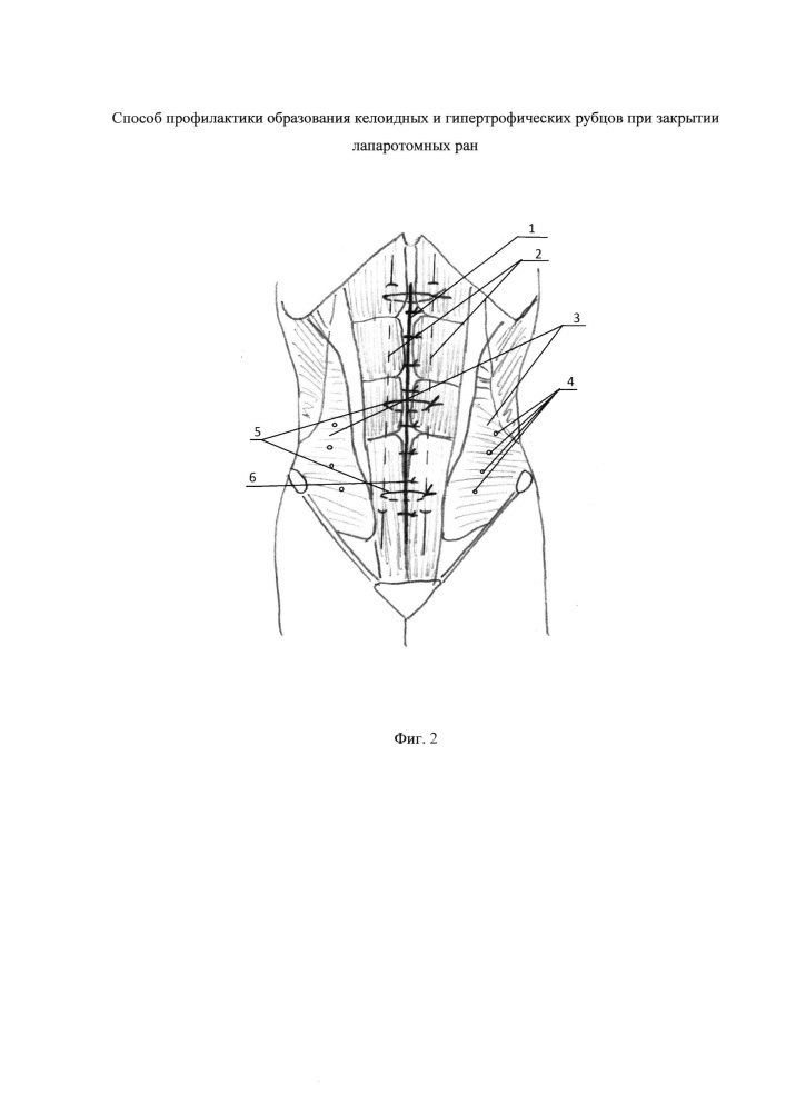Способ профилактики образования келоидных и гипертрофических рубцов при закрытии лапаротомных ран (патент 2643332)
