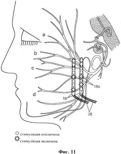 Система и способ стимуляции лицевого нерва (патент 2511082)