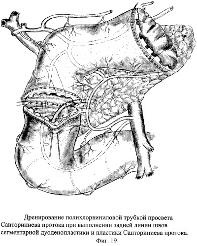 Способ хирургического лечения низких осложненных пенетрацией и кровотечением гигантских дуоденальных язв (патент 2259169)