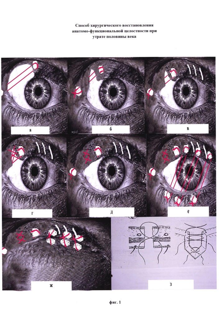 Способ хирургического восстановления анатомо-функциональной целостности при утрате половины века (патент 2611993)