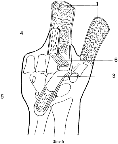 Способ реконструкции кисти при ампутационных культях всех пальцев (патент 2572551)