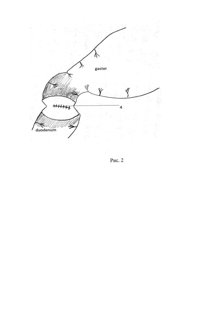 Способ хирургического лечения осложненной язвы двенадцатиперстной кишки (патент 2618649)