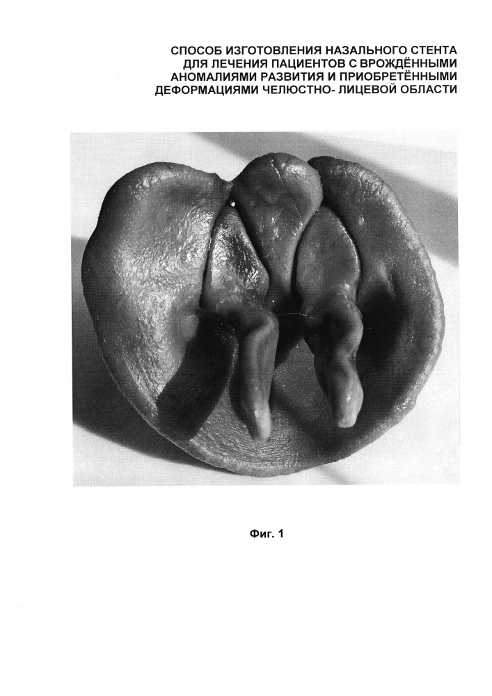 Способ изготовления назального стента для лечения пациентов с врождёнными аномалиями развития и приобретёнными деформациями челюстно-лицевой области (патент 2618187)